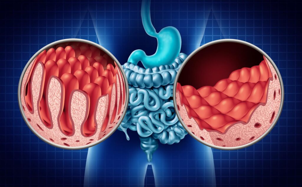 CELIAC DISEASE