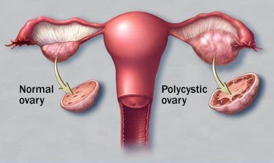 Polycystic ovary syndrome