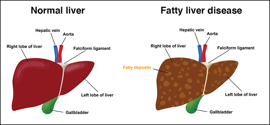 WHAT IS FATTY LIVER ?